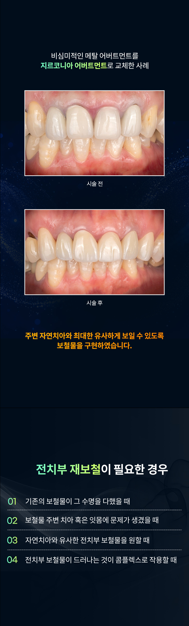전치부 재보철 모바일 이미지