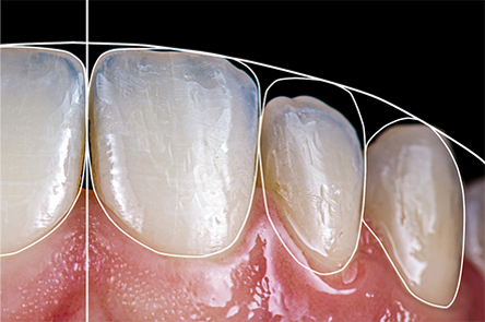 해피네이트의 우수한 심미성 사진