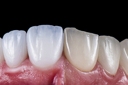 해피네이트의 우수한 심미성 사진