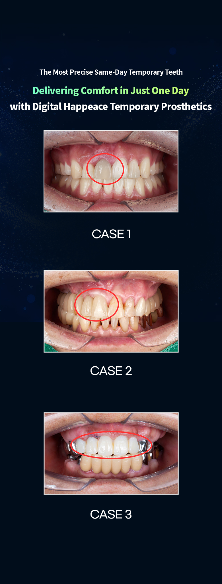 Same-day temporary teeth after implant placement, with three intraoral cases (Case 1 to 3)