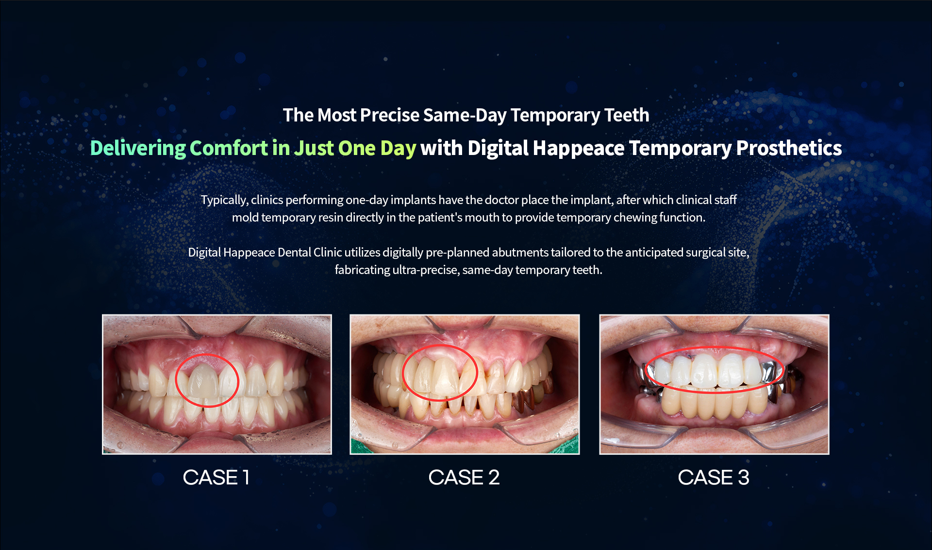 Same-day temporary teeth after implant placement, with three intraoral cases (Case 1 to 3)