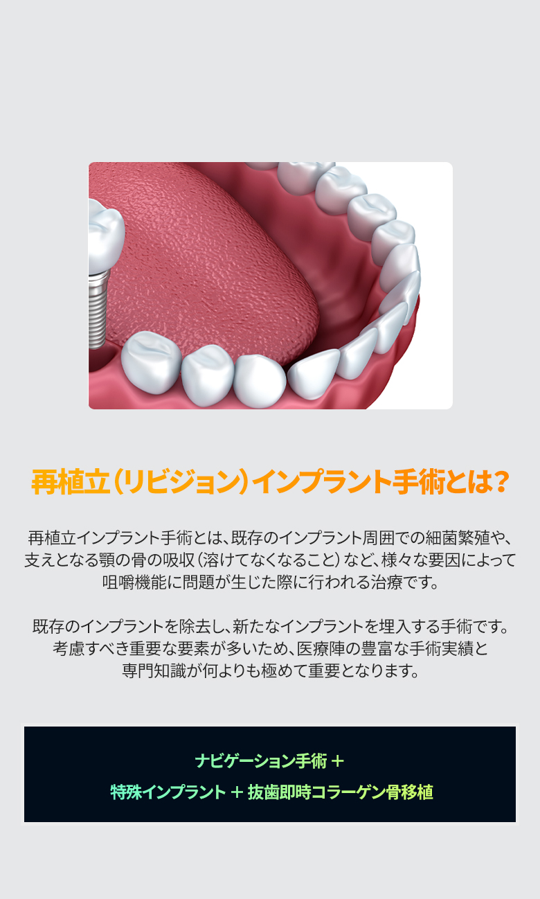 再植立(リビジョン)インプラント手術の紹介