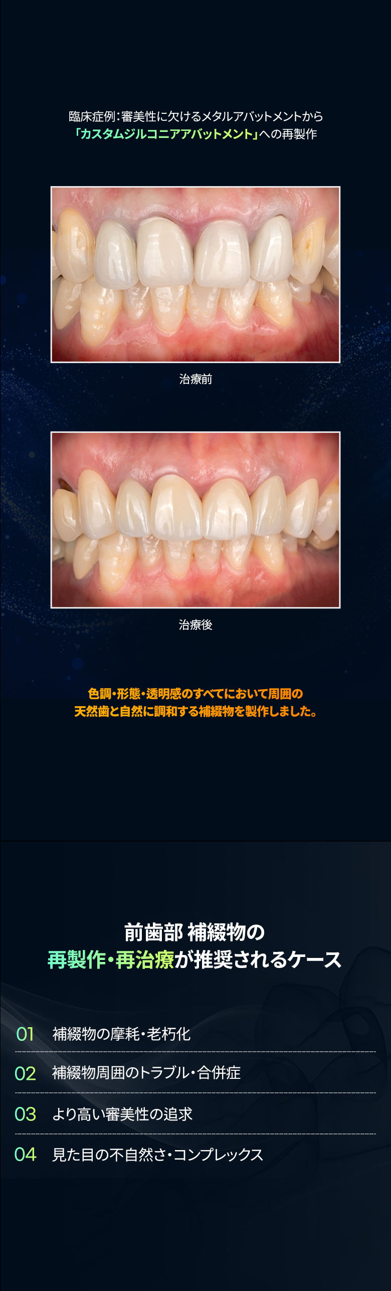前歯補綴 モバイル用画像